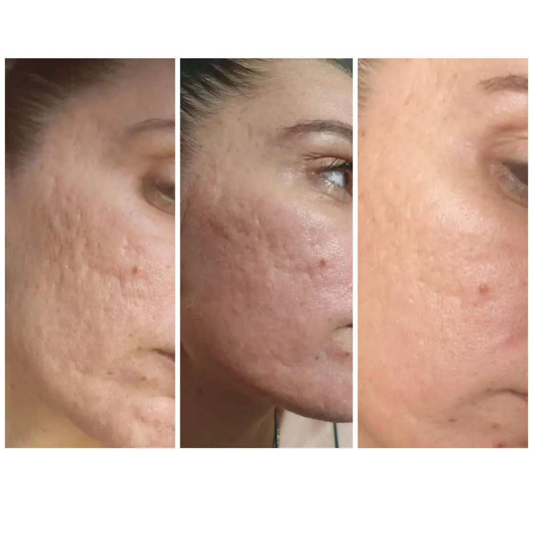 Customer before and after acne-related skin improvement