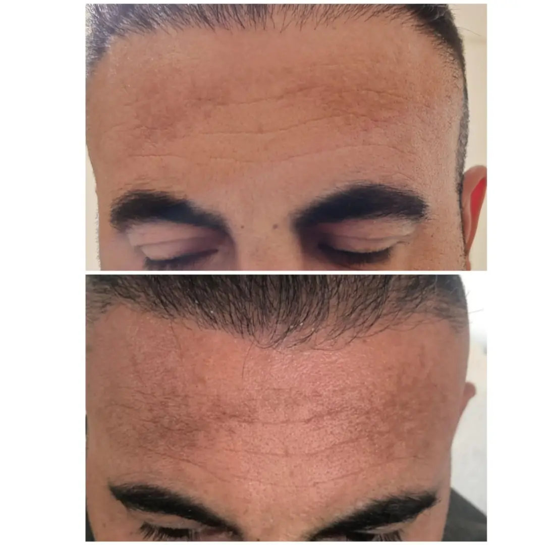 Customer before and after pigmentation improvement on forehead